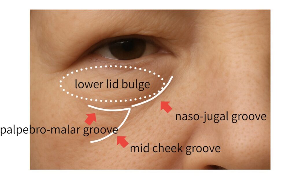下まぶたの加齢による変化でできるしわ