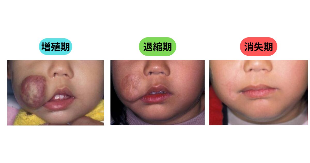 乳児血管腫 実際の症例写真（増殖期・退縮期・消失期）